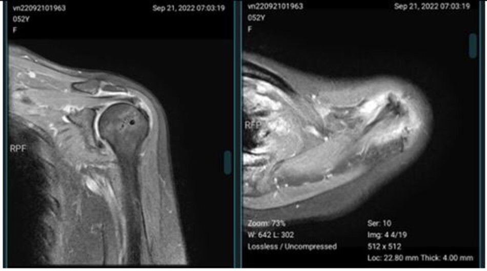 Hình ảnh cộng hưởng từ sau mổ 6 tháng