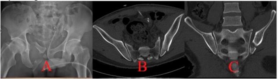 Hình ảnh vỡ xương chậu phức tạp
