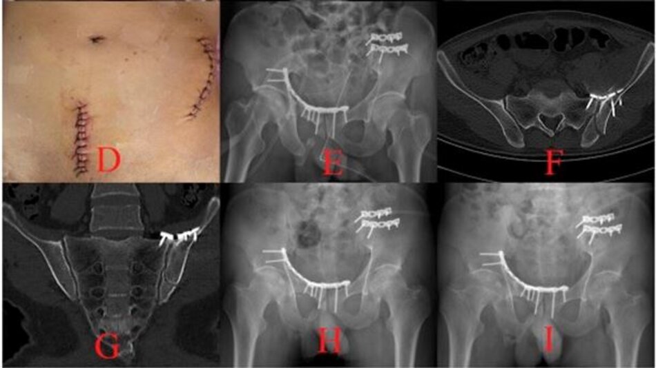 Hình ảnh đường mổ và phim chụp sau mổ đạt kết quả đúng giải phẫu