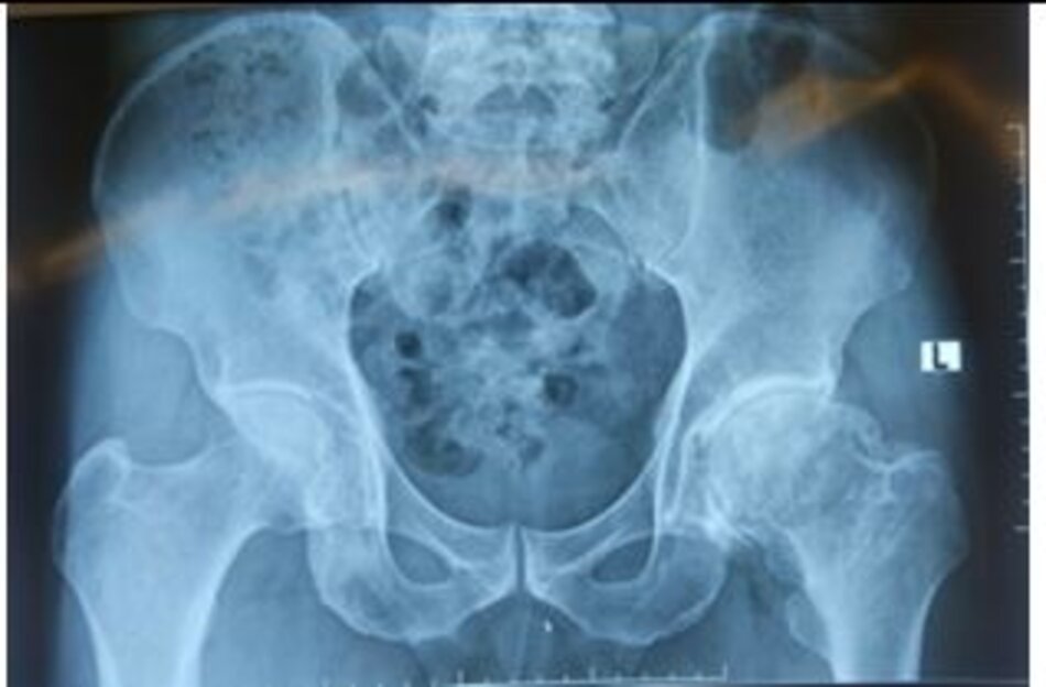 Xquang trước mổHình ảnh hoại tử chỏm xương đùi trái
