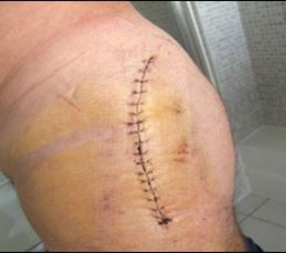 Hình ảnh đường mổ