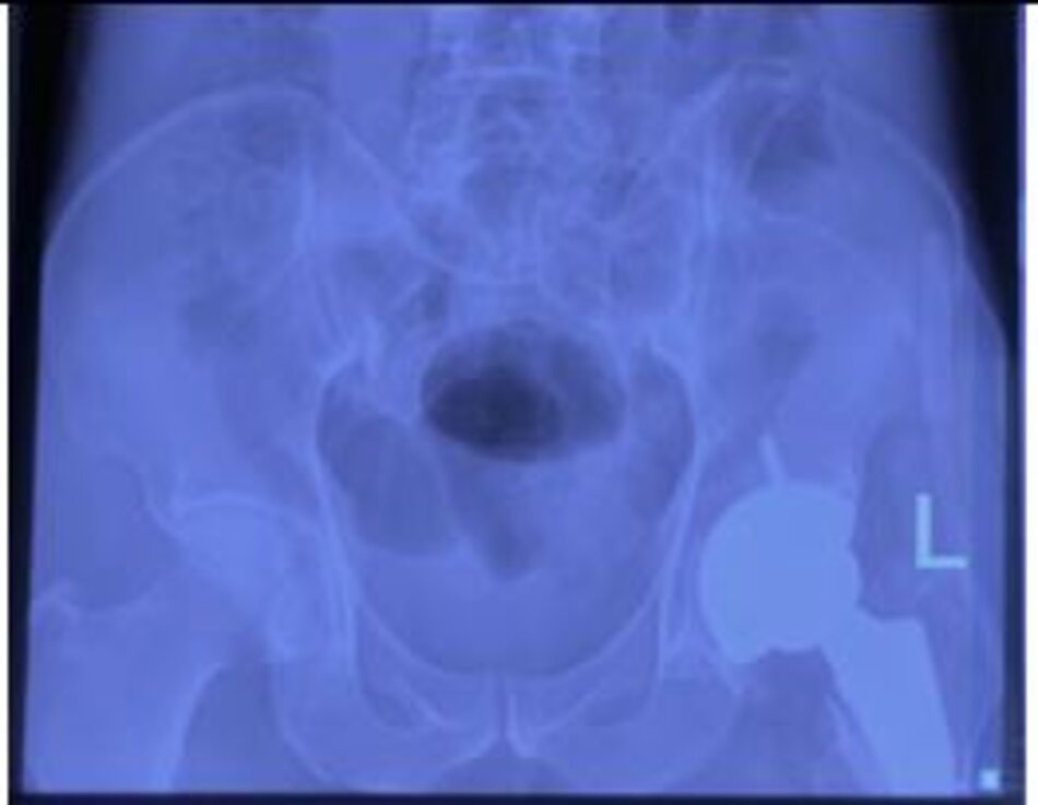 Xquang sau mổ. Hình ảnh khớp háng trái nhân tạo