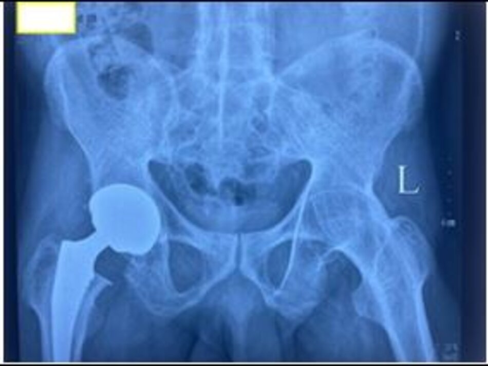 Xquang sau mổHình ảnh khớp háng trái nhân tạo
Xquang sau mổ, BN đã có thể cử động khớp háng và tập đi lại ngày thứ 3 sau phẫu thuật
