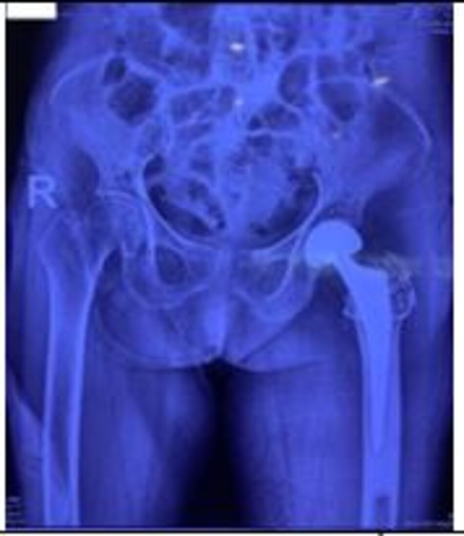 Xquang sau mổBệnh nhân được ngồi dậy ngay sau mổ, tập đi sau mổ 1 tuần
