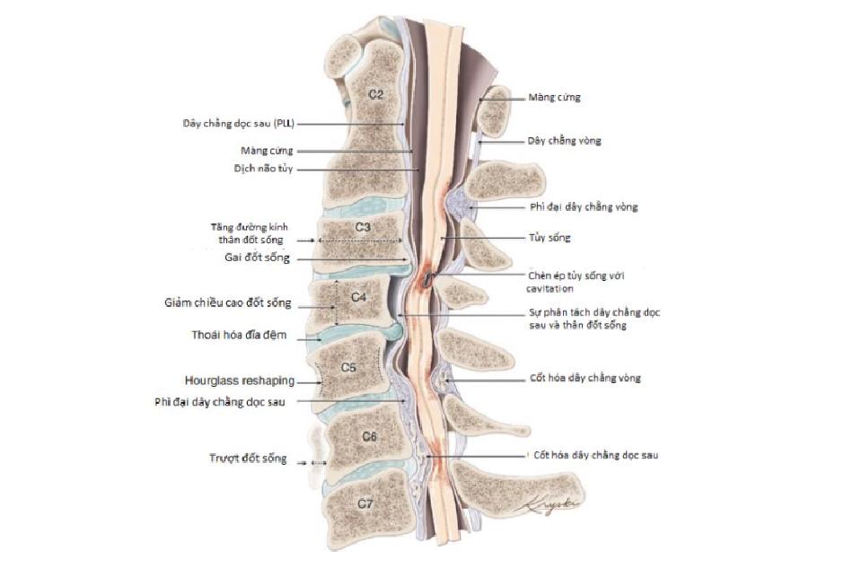 Các nguyên nhân gây hẹp ống sống cổ