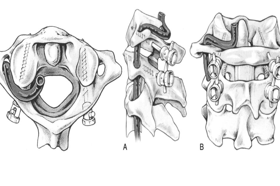 Độ CHÍNH XÁC VÍT QUA KHỚP ĐIỂU TRỊ MẤT VỮNG C1 - C2
