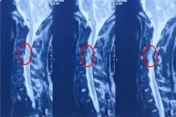 Hình ảnh áp xe trong ống sống vị trí C3C4 gây chèn ép tủy nặng