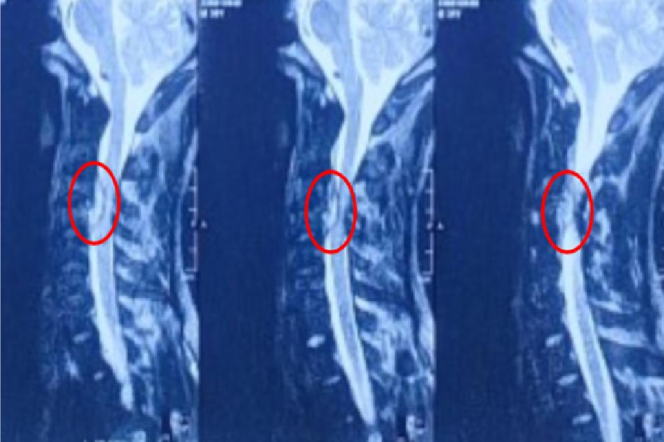 Hình ảnh áp xe trong ống sống vị trí C3C4 gây chèn ép tủy nặng