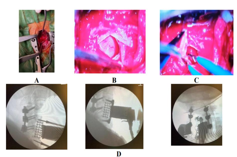 Hình ảnh phẫu thuật lần thứ 2