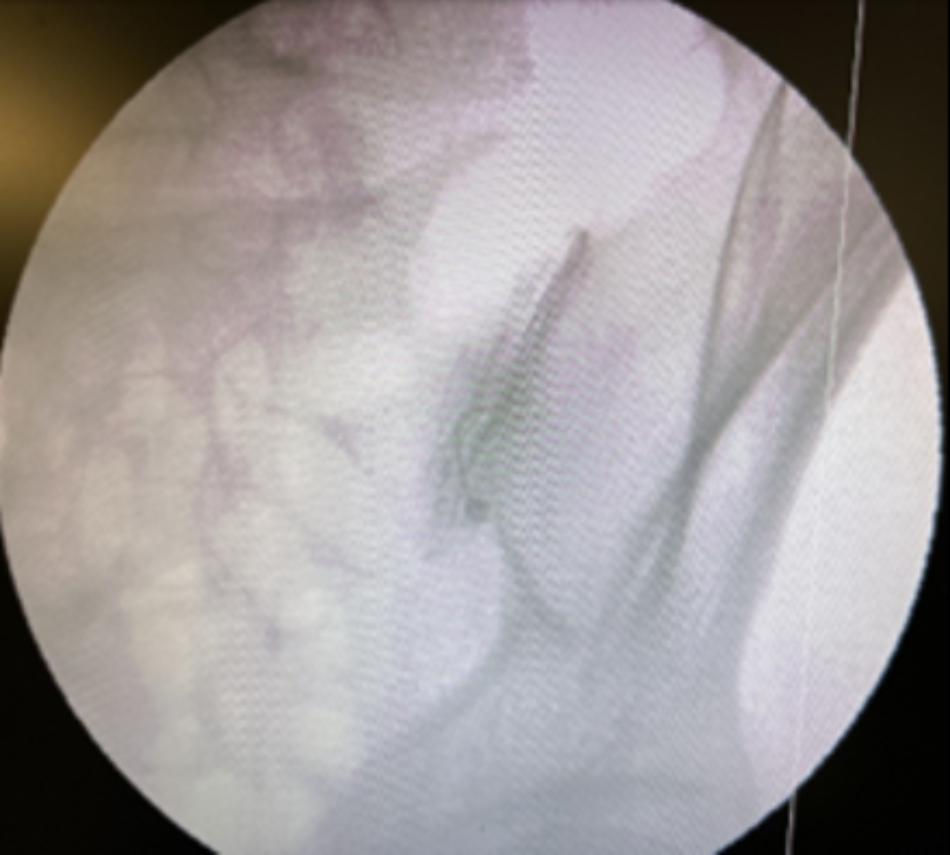 Hình ảnh tiêm phong bế khớp cùng chậu dưới Carm. Thuốc cản quang được tiêm vào trước để xác định chính xác kim tiêm vào nội khớp. 