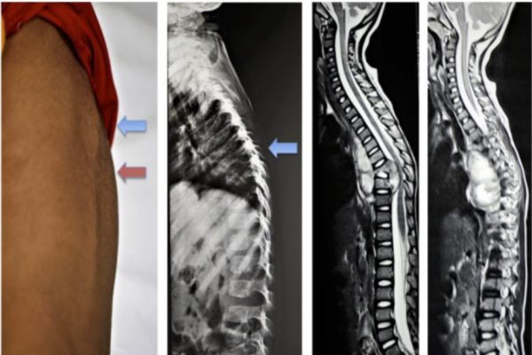 Hình ảnh tổn thương thân đốt sống T8T9, áp xe quanh đốt sống và trong ống sống ở bệnh nhân 9 tuổi