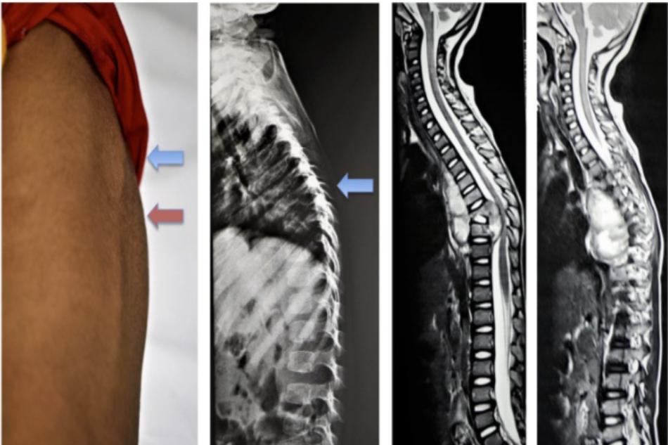 Hình ảnh tổn thương thân đốt sống T8T9, áp xe quanh đốt sống và trong ống sống ở bệnh nhân 9 tuổi