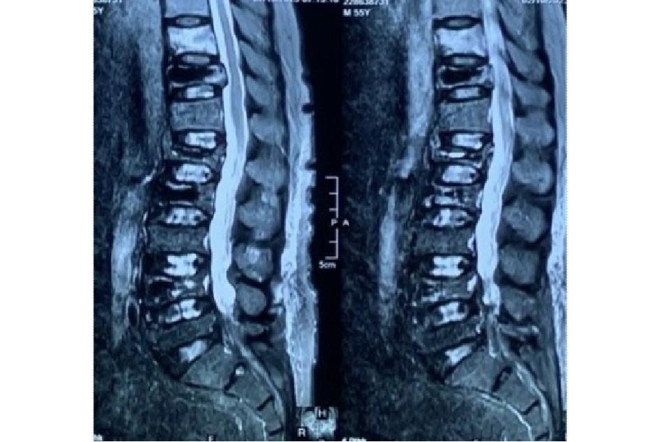 Hình ảnh xẹp phù nề thân đốt sống T10 ở bệnh nhân đã bơm xi măng các đốt sống T11L1L2L4