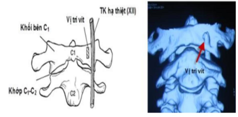 Liên quan vị trí vít và TK XII