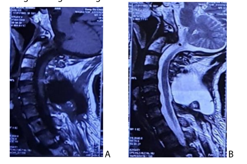 MRI cột sông cổ sau mổ lần đầu 2 năm