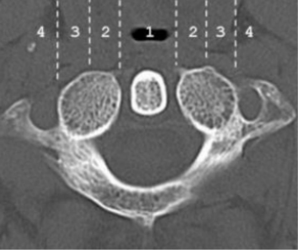 Phân chia khối bên C1 theo 4 vùng giải phẫu