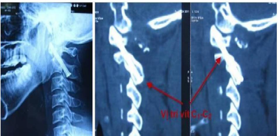 Vị trí vít C1 - c2 trên phim chụp CLVT tư thế đứng dọc