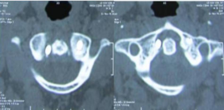 Vít vào trong ống sống