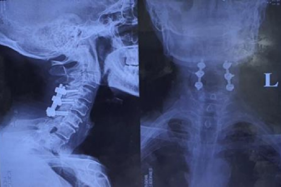 X-quang cột sống cổ