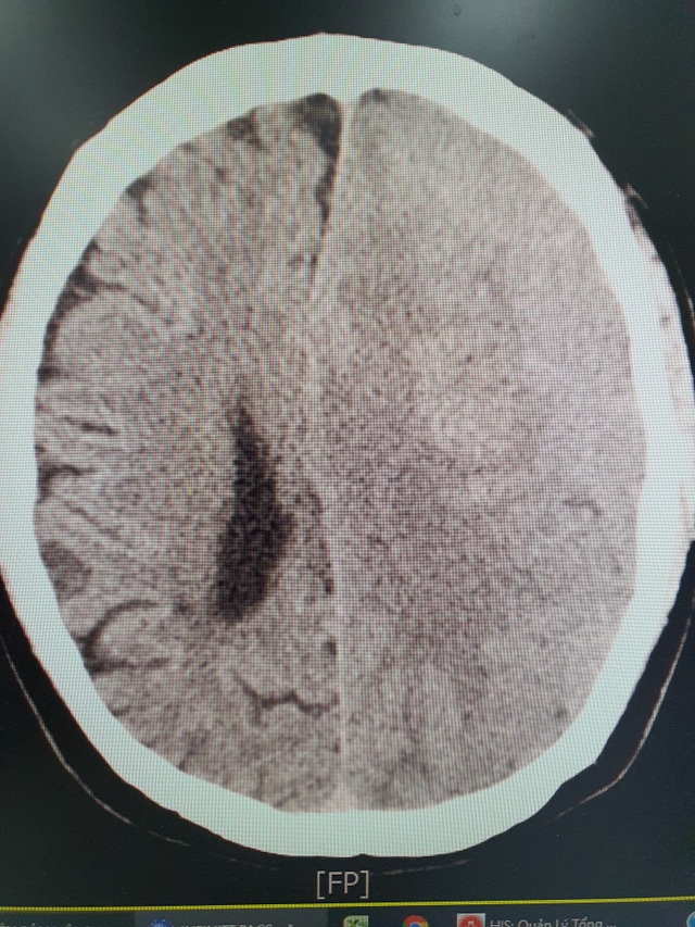 Hà Nội: Người đàn ông hôn mê vì uống an cung ngưu hoàng ngừa tai biến não - 1