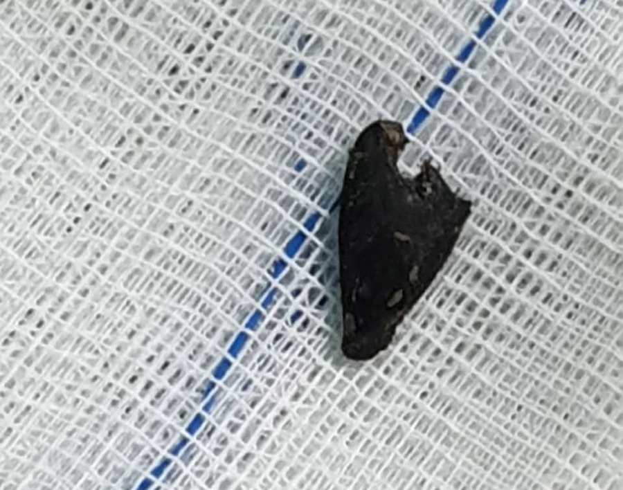 Đau ngực và ho hơn 1 tháng, người đàn ông không ngờ thủ phạm là hạt vú sữa