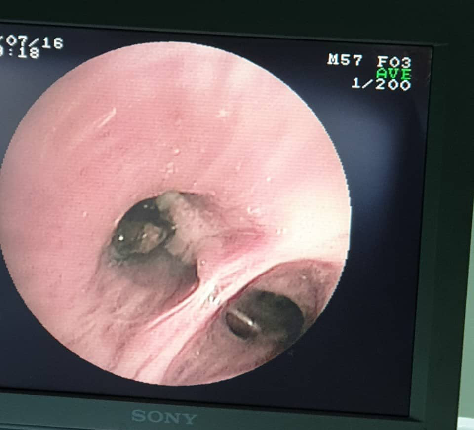 Đau ngực và ho hơn 1 tháng, người đàn ông không ngờ thủ phạm là hạt vú sữa