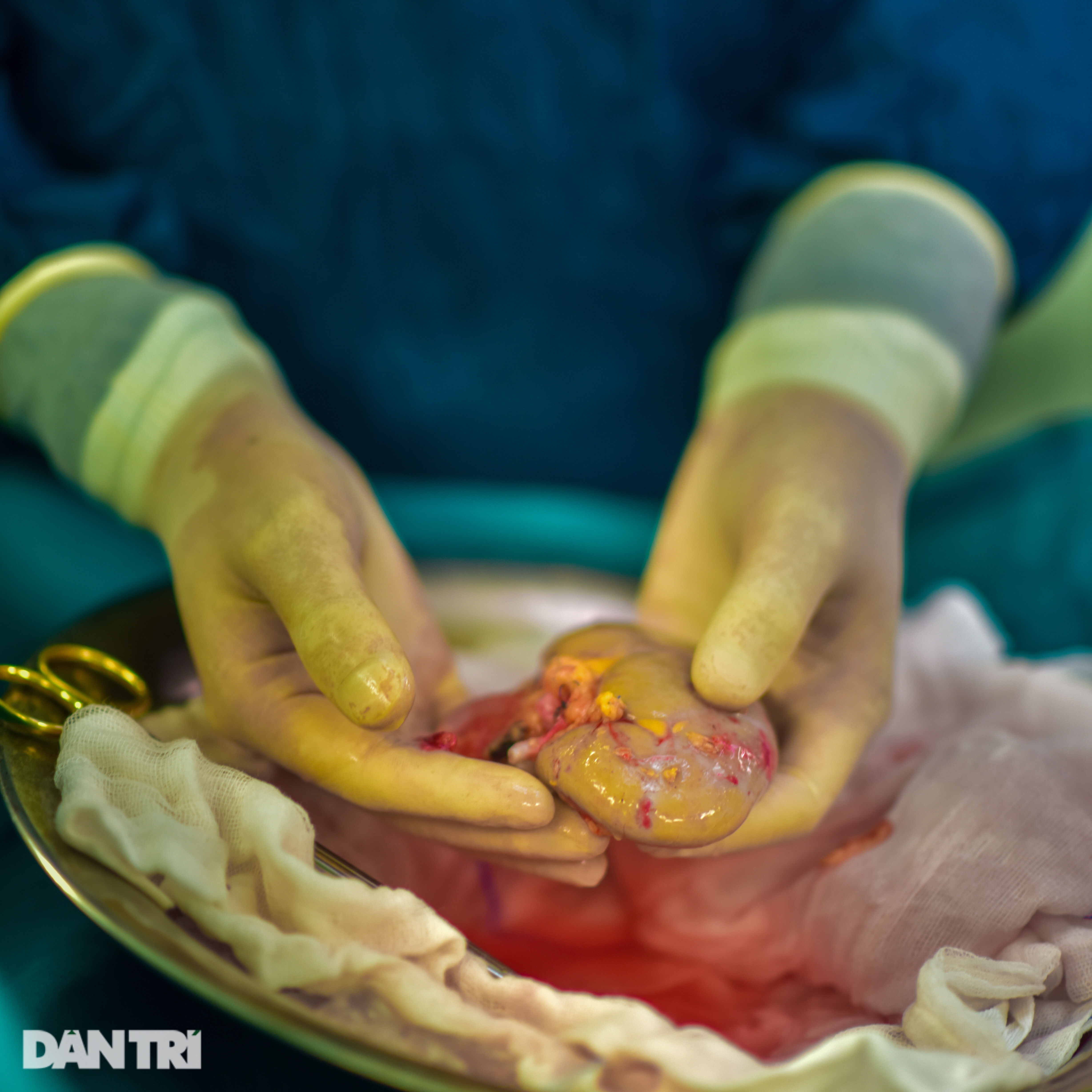 Bên trong phòng mổ đặc biệt, nơi cứu sống hàng nghìn người ở BV Bạch Mai - 12