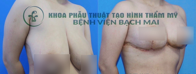 Người phụ nữ xinh đẹp bỗng hóa xồ xề, ngực chảy đến rốn sau 2 lần sinh nở bởi chứng bệnh nghe xong chỉ chực khóc hết nước mắt - Ảnh 3.