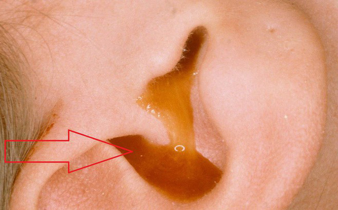 Nghìn mẹ Việt  truyền nhau chữa viêm tai giữa bằng cách thổi sáp ong