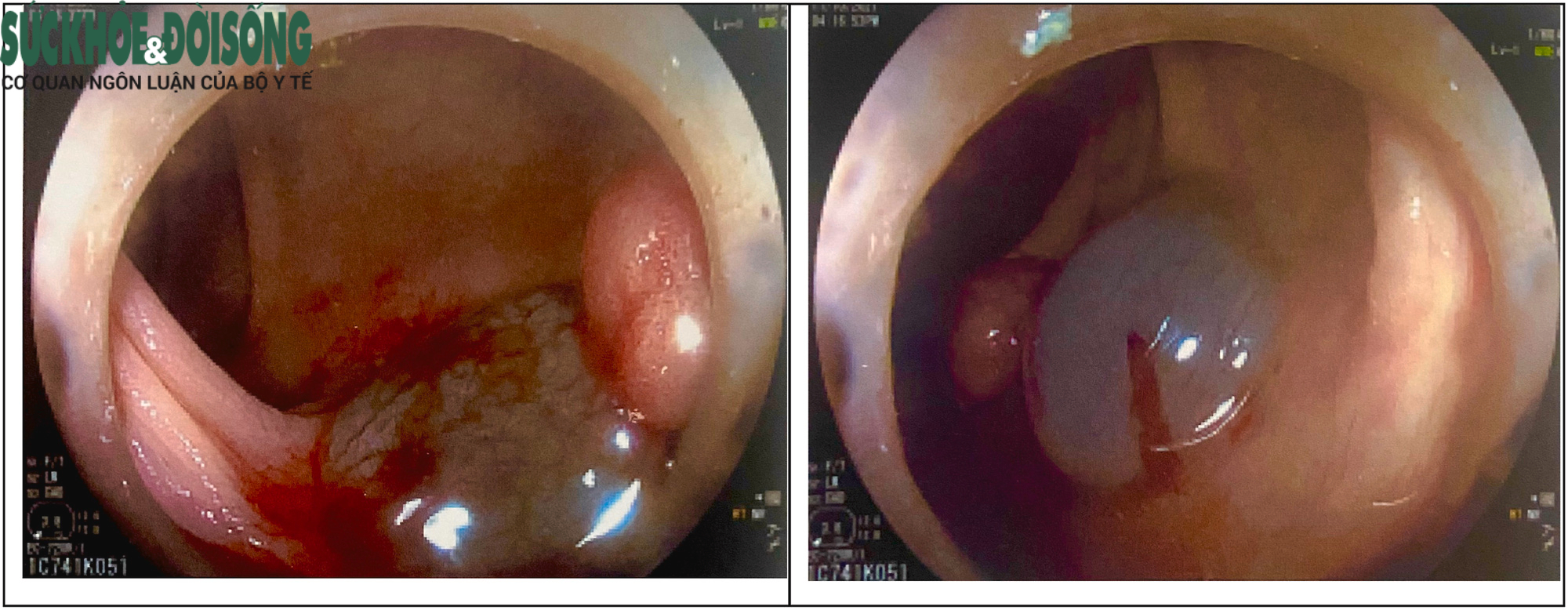 Tiêm máu tự thân 'chỉ điểm' vị trí ung thư đại tràng - Ảnh 2.